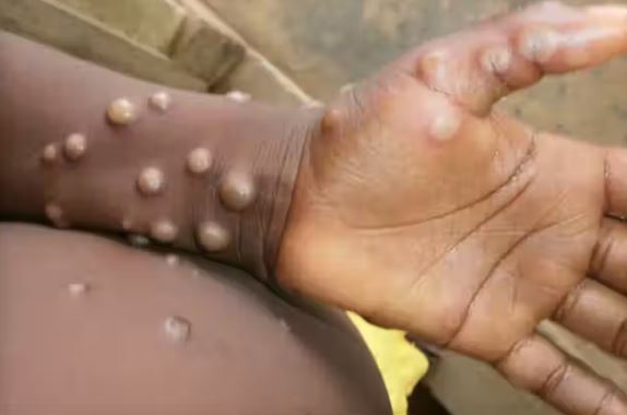 La OMS declara la emergencia de salud pública internacional por el brote de Mpox