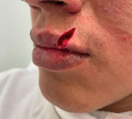 Lesionado tras recibir un botellazo en la cara en una discoteca de Abejeras
