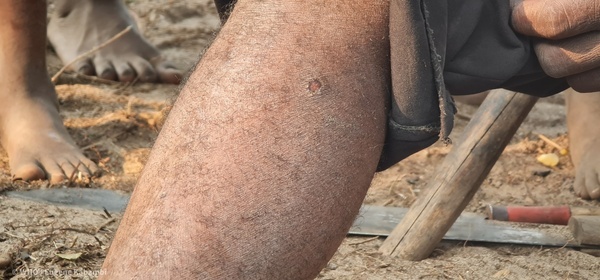 La OMS lanza una guía con preguntas y respuestas sobre la Mpox