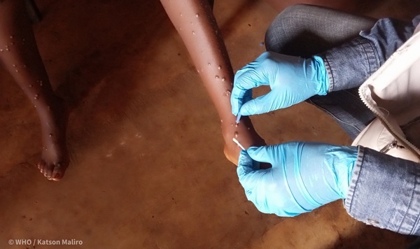  Sanidad refuerza las medidas para la vigilancia del Mpox como la notificación de nuevos casos