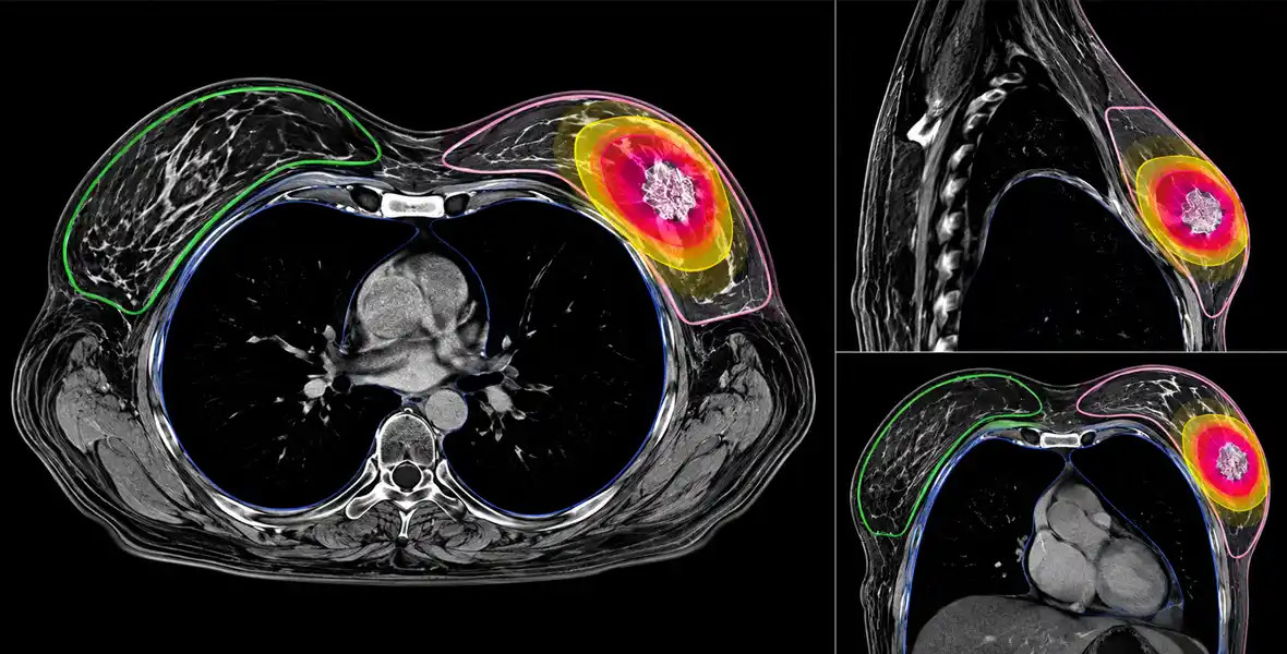 Una radioterapia de solo cinco días y mínimo volumen logra resultados muy favorables en cáncer de mama precoz